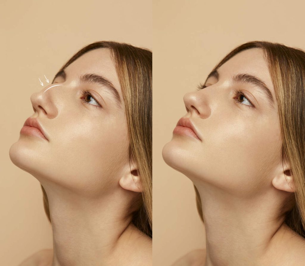 Rinoplastia: tem como escolher o formato do nariz?