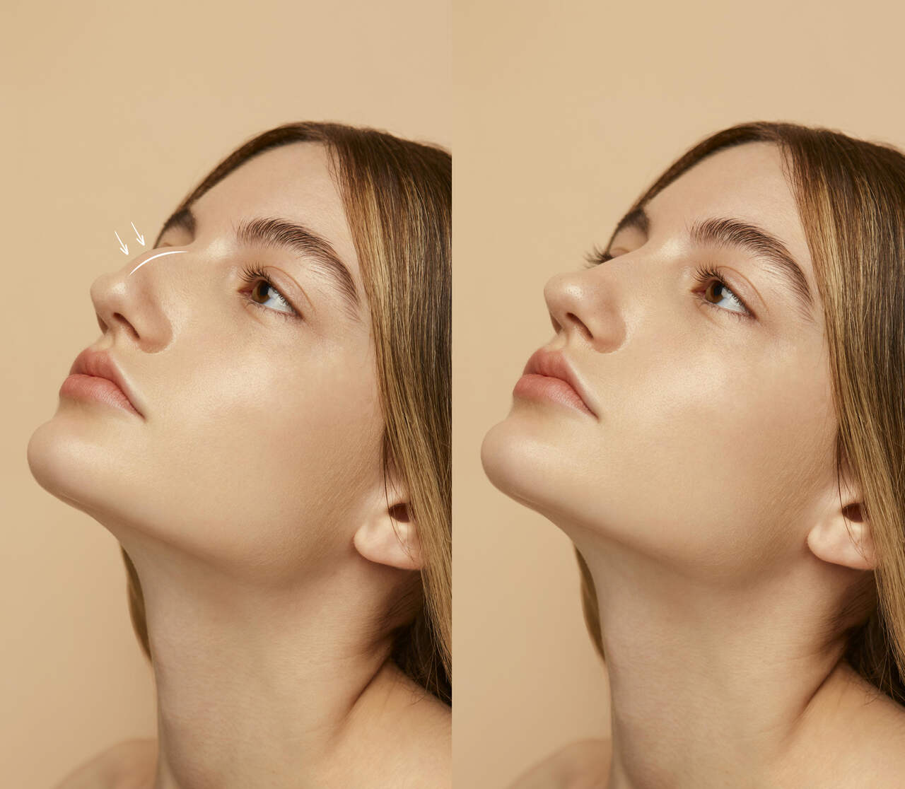 Rinoplastia: tem como escolher o formato do nariz?
